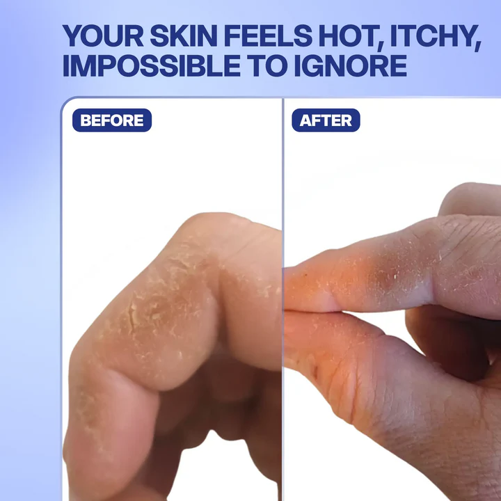 CalmSkin® Flare Patches